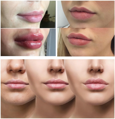 Beauty Clinic Spa HA Dermal Filler على شكل ملامح الوجه تضيف حجم التجاعيد حشو