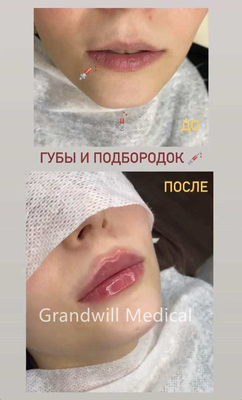 24mg/ ml حامض حمض الهيالورونيك الجلدي لملء التجاعيد