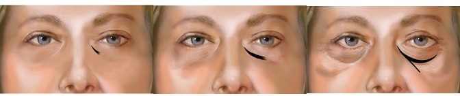 1 مل 2 مل محلول حمض الهيالورونيك عن طريق الحقن يزيل علاج الهالات السوداء للعيون