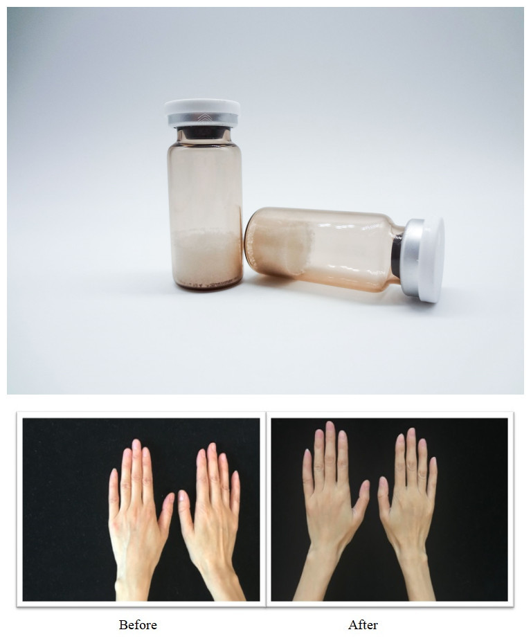 ملءات الجلد القابلة للعقمة للوجوه PLLA حمض الهيالورونيك جيل حقن مصمم لتصحيح التجاعيد السلسة واستعادة حجم الوجه