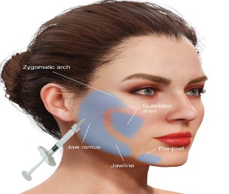حمض الهيالورونيك HA الكالسيوم هيدروكسياباتيت ملء الحصول على وجه طبيعي المظهر مع 1ML حقنة